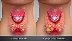 3D Medical Animation still shot showing Hyperparathyroidism