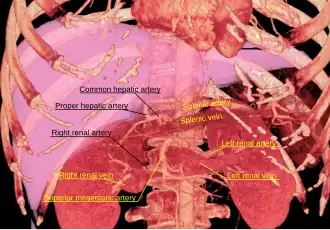 3D-rendered computed tomography, showing splenic artery at upper right.