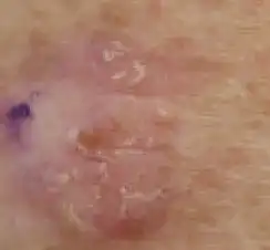 Close up of piece of skin showing pink patches with raised white scales