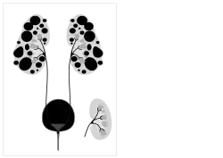 Diagram of autosomal dominant polycystic disease with a normal kidney inset for comparison