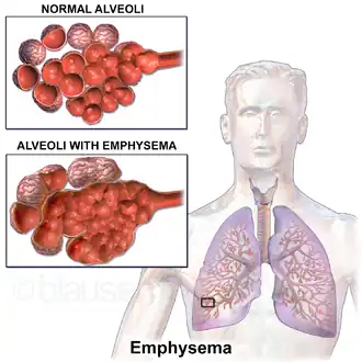 A diagram comparing normal alveoli to those with emphysema