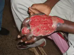 Ulceration of the skin over the back of a teenager's hand