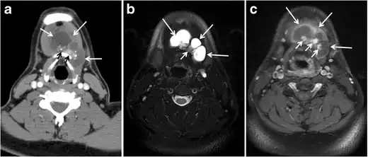 Fig. 21. Papillary thyroid carcinoma arising from a thyroglossal duct cyst in a 28-year-old male. an Axial enhanced CT scan shows a large complex cystic lesion (white arrows) adherent to the anterior aspect of the hyoid bone. It has an enhancing mural solid nodules and calcifications (black arrows). There is no cervical lymphadenopathy. b Axial short tau inversion recovery (STIR) MRI image near the same level shows complex lesion of high signal intensity (long white arrows) with solid mural nodules (short white arrow). c Axial fat saturated T1 MRI image post contrast administration shows the complex cystic lesion with thick enhancing wall (long white arrows) and enhancing mural nodules (short white arrows).[1]