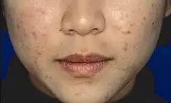 Acne ridden face