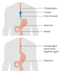 Diagram showing before and after a partial oesophagectomy