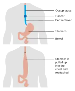 Diagram showing before and after a total oesophagectomy