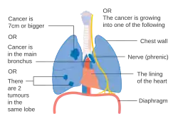 One option for stage IIB lung cancer, with T2b; but if tumor is within 2&nbsp;cm of the carina, this is stage 3