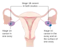 Stage 1 ovarian cancer
