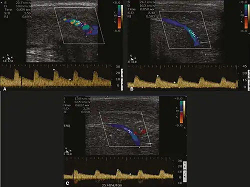 Longitudinal, ventral ultrasound of the penis, with pulsed mode and color Doppler. Flow of the cavernous arteries at 5, 15, and 25 min after prostaglandin injection (A, B, and C, respectively). The cavernous artery flow remains below the expected levels (at least 25–35&nbsp;cm/s), which indicates ED due to arterial insufficiency.[48]