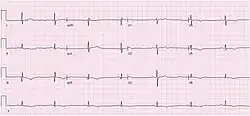 An ECG showing sinus bradycardia at 43 bpm. The image is made up of a red grid on a white background. A black line traces the patients heart beat.