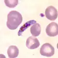 Plasmodium falciparum, the causative agent of malaria, infecting blood cells