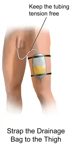 Foley Catheter Drainage Illustration