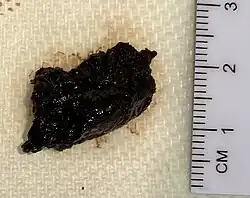 Gross pathology of melanoma metastasis, which is pigment-forming in a vast majority of cases, giving it a dark appearance