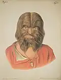 Image of a lithograph from Hebra's Atlas showing a man in red shirt whose face is completely covered in brown hair.