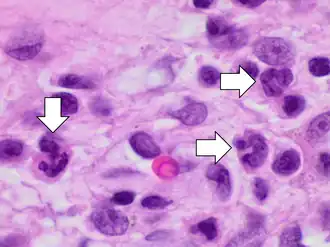Acute inflammation characterized by neutrophils