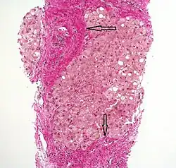Histopathology of steatohepatitis with established cirrhosis, with thick bands of fibrosis (Van Gieson's stain)[97]