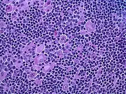 Hodgkin lymphoma, nodular lymphocyte predominant (high-power view): Notice the presence of L&H cells, also known as "popcorn cells". (H&E)