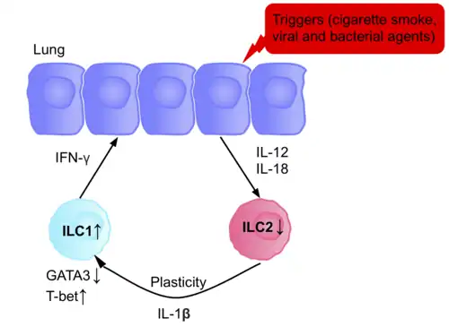 The lung epithelium after being triggered, by cigarette smoke, and the resulting effect this has on the ILCs in the microenvironment, in patients with COPD. This diagram displays the plasticity between the ILC2 and ILC1 cells in the presence of this trigger, and the cytokine IL-1B, causing an increase in the presence of ILC1, increasing the inflammation, and therefore contributing to the pathophysiology of the disease.
