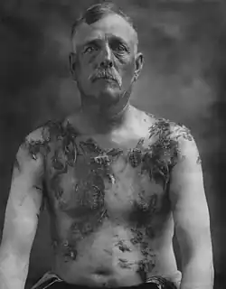 German American farmer John Meints of Minnesota was tarred and feathered in August 1918 for allegedly not supporting war bond drives.