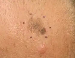 Melanoma, vertex scalp marked for biopsy