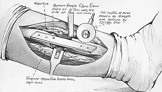 Image of a fractured tibia, shown in black and white but painted in watercolours, with an aluminium template nailed to the periosteum.