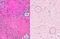 Histopathology, showing epithelioid granulomas with multinucleated giant cells and acid-fast bacilli