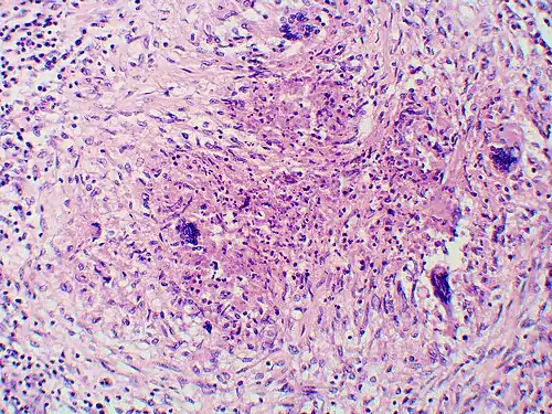 Granuloma with early suppuration. The fungal organisms are difficult to recognize at this low magnification.