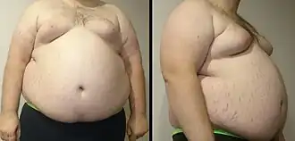 A front and side view of a "class III obese male" torso. Stretch marks of the skin are visible along with gynecomastia.