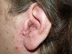 Exudate over a background of redness on the external ear canal of an adult