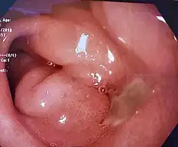 Endoscopy photo of a peptic ulcer