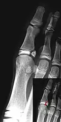 Salter–Harris IV fracture of big toe proximal phalanx.