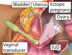Transvaginal ultrasonography of an ectopic pregnancy, showing the field of view in the following image