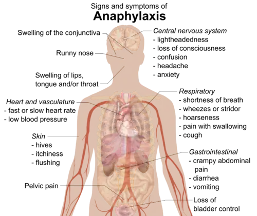 Signs and symptoms of anaphylaxis