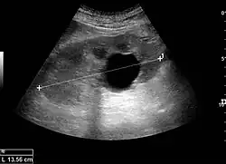 Renal ultrasonography of a simple renal cyst with posterior enhancement.