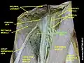 Femoral sheath