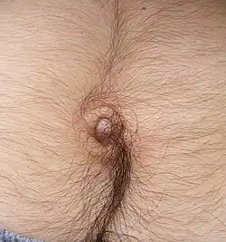 Sagittal hair growth above and below the navel