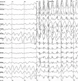 Graph showing 16 voltage traces going across the page from left to right, each showing a different signal. At the middle of the page all of the traces abruptly begin to show sharp jerky spikes, which continue to the end of the plot.