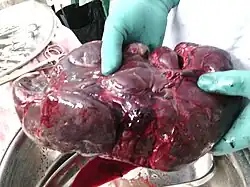 Surgically removed spleen of a child with thalassemia. It is about 15 times larger than normal.