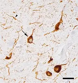 Micrograph of tauopathy (brown) in a neuronal cell body (arrow) and process (arrowhead) in the cerebral cortex of a patient with Alzheimer's disease. Bar = 25 microns (0.025mm).