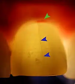 Transillumination demonstrating fracture