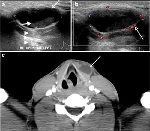 Fig. 19. Long-standing infected thyroglossal duct cyst in a 29-year-old male patient. a Transverse greyscale ultrasound at midline, just above the level of the thyroid gland, shows an oval cystic lesion with internal echoes (white arrows) and posterior enhancement (arrowheads). b Transverse colour Doppler ultrasound shows surrounding peripheral flow (white arrow). c Axial enhanced neck CT scan at the level of the thyroid cartilage demonstrates a slightly off-midline, well-defined, homogeneous cystic lesion embedded in the left strap muscle with peripheral enhancement (white arrow). It shows no calcification or internal enhancement. Thyroid gland was normal (not shown).[1]