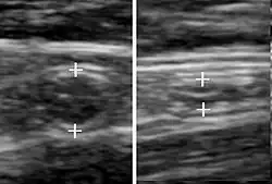A normal appendix without and with compression. Absence of compressibility indicates appendicitis.[59]