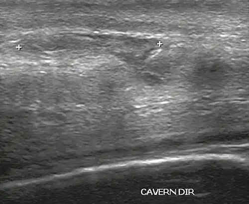 Figure 4 A: Ultrasound of the penis, right lateral view. Longitudinal section showing rupture of the tunica albuginea with an adjacent 1.92&nbsp;cm hematoma (between calipers), due to trauma.[2]