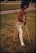 Young man in full leg plaster cast in 1974