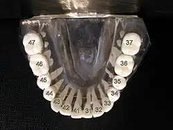 ISO notation lower jaw (wisdom teeth removed)