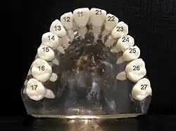 ISO notation upper jaw (wisdom teeth removed)